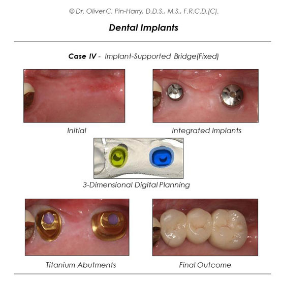 Dental Implants and Back Teeth