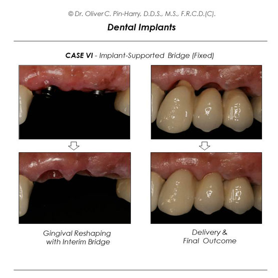 Dental Implants and Bridge