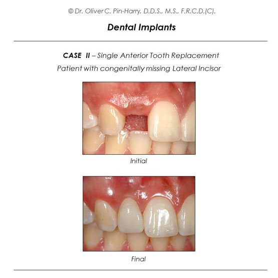 Front Tooth Implant
